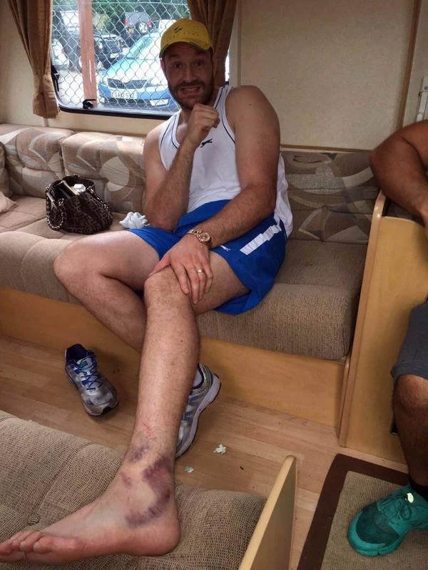 Chấn thương ở cổ chân khiến Tyson Fury dời ngày tái đấu.